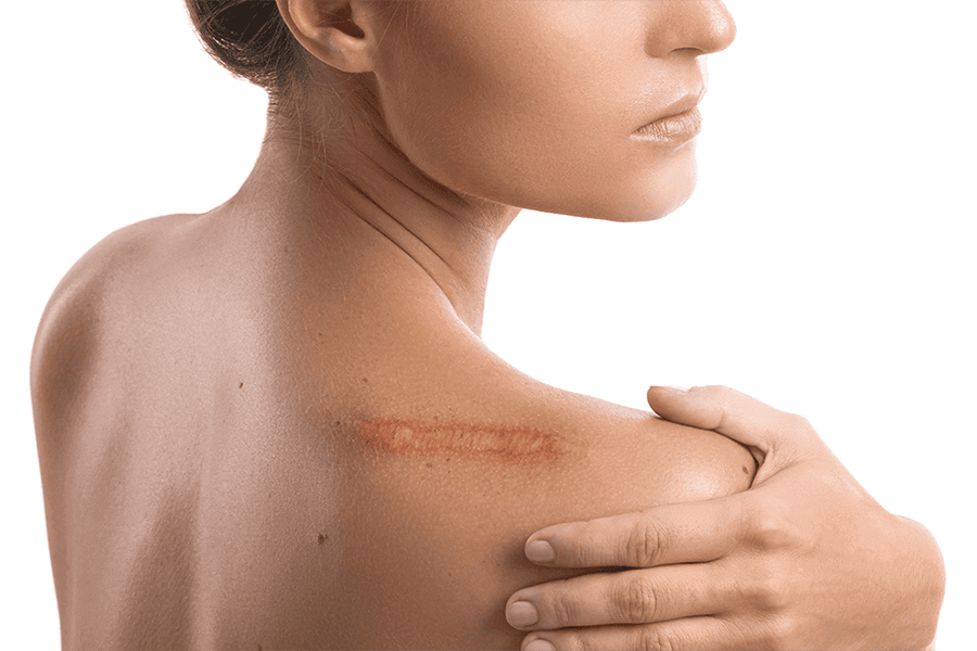 常見的疤痕類型有哪些？ 又該如何治療 ?