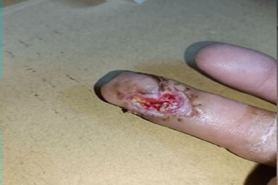 手指切割傷之案例