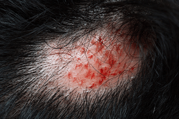 傷口紅腫反覆，照護難以持續