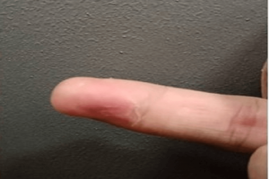 全馨傷口共照網照護實例~12天手指切割傷痊癒案例