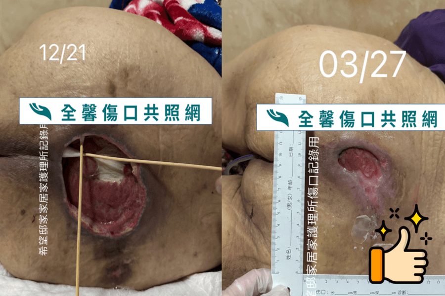 全馨傷口共照網照護實例~四級壓瘡3個月縮小84%案例
