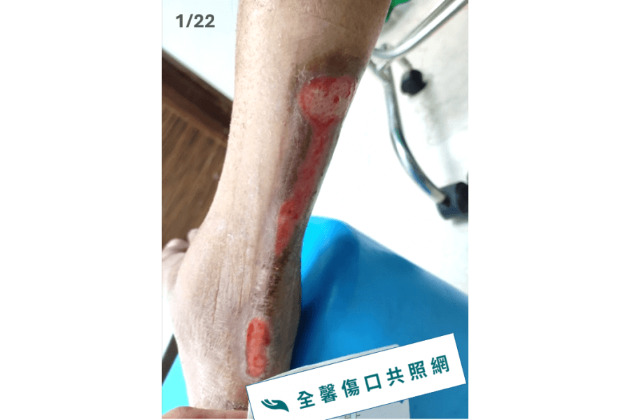 全馨傷口共照網照護實例~20天騎車犁田擦傷痊癒案例