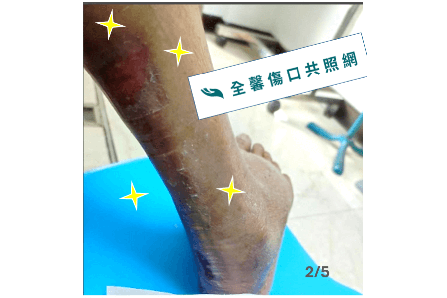 全馨傷口共照網照護實例~20天騎車犁田擦傷痊癒案例