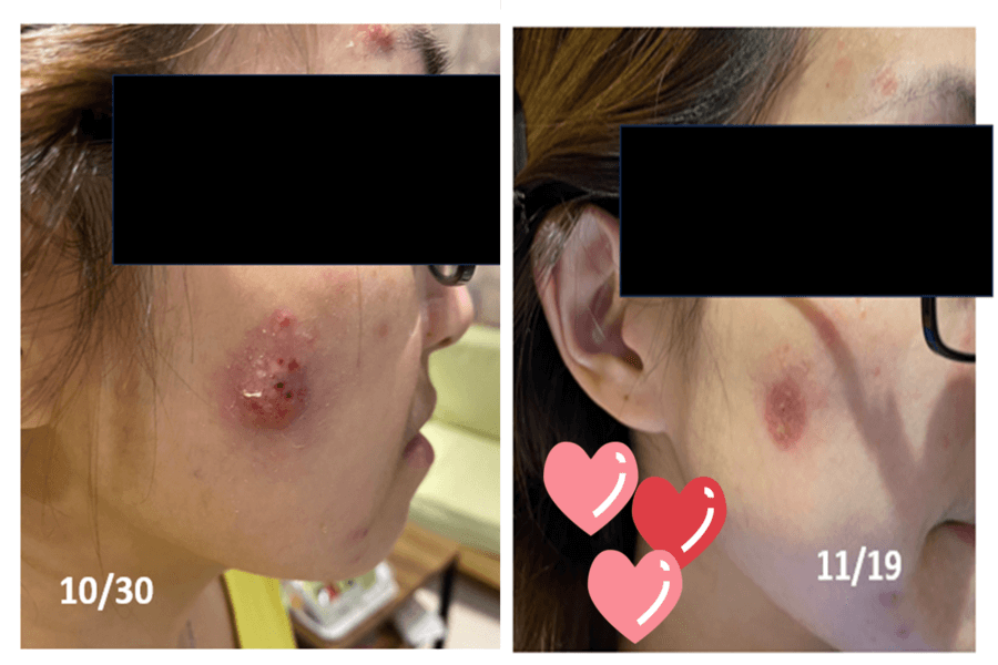 全馨傷口共照網照護實例~ 19天臉部痘痘化膿改善紀錄