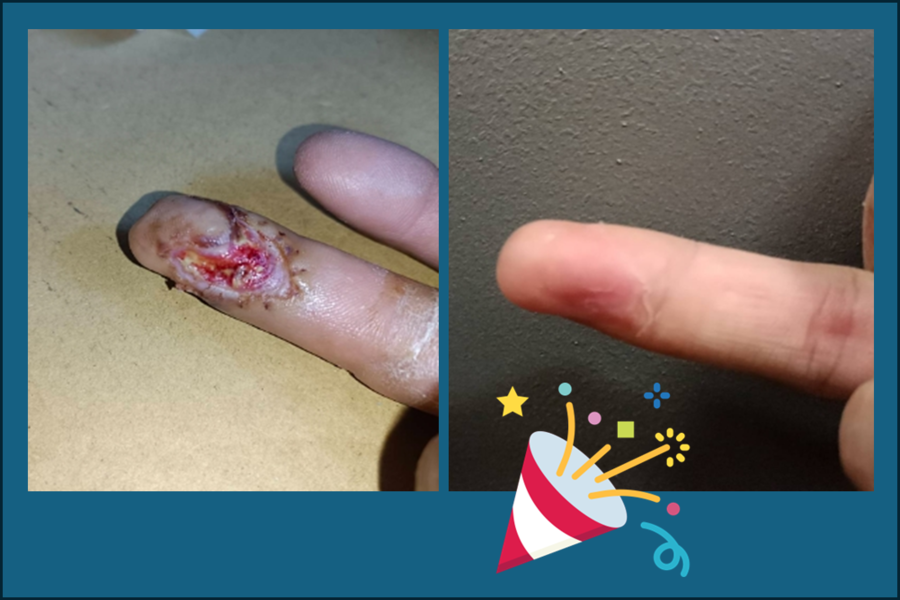 手指切割傷之案例