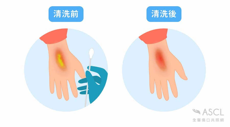 清洗傷口