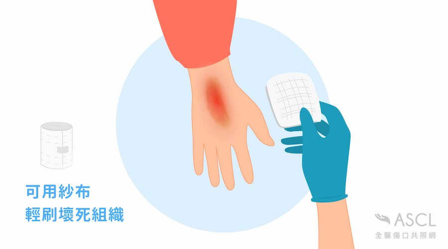 移除壞死組織