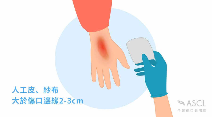 敷料覆蓋傷口