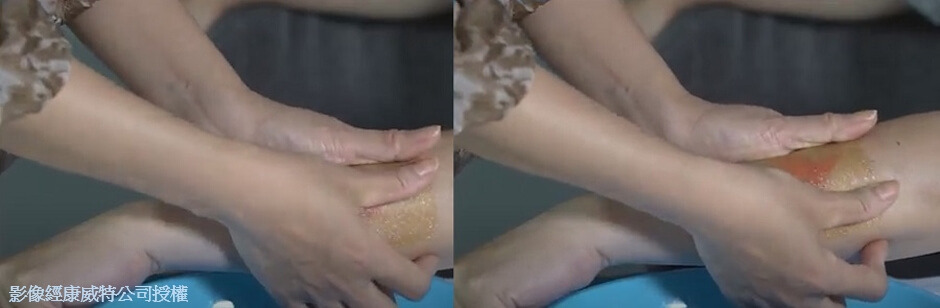 覆蓋人工皮 覆蓋人工皮
