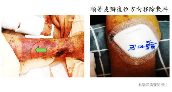 撕除傷照護