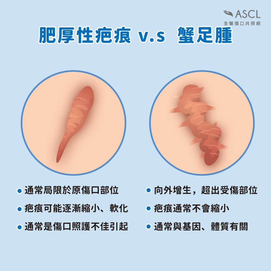 肥厚性疤痕與蟹足腫比對 肥厚性疤痕與蟹足腫比對