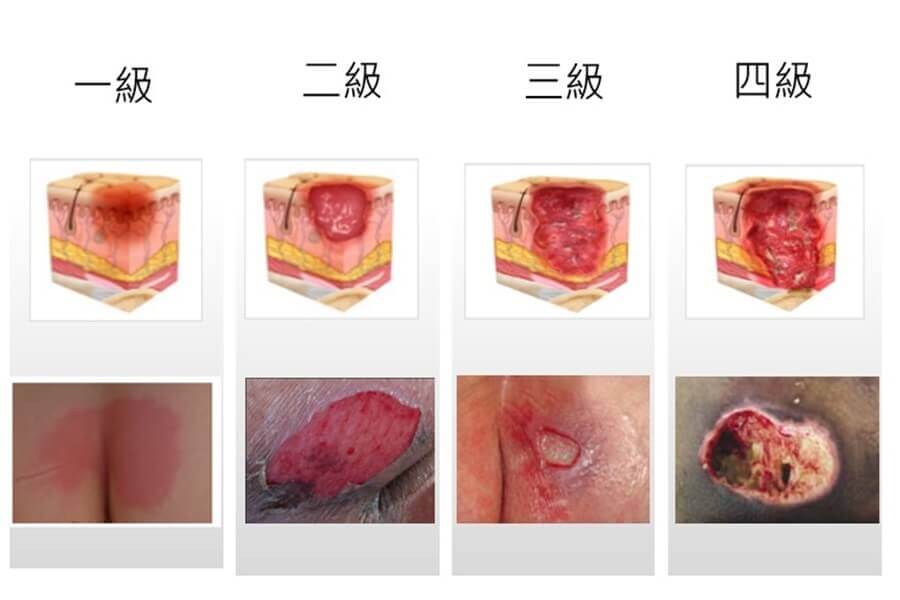 壓瘡分級