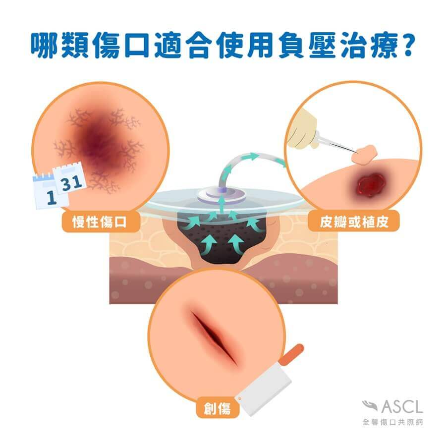適合負壓治療的傷口