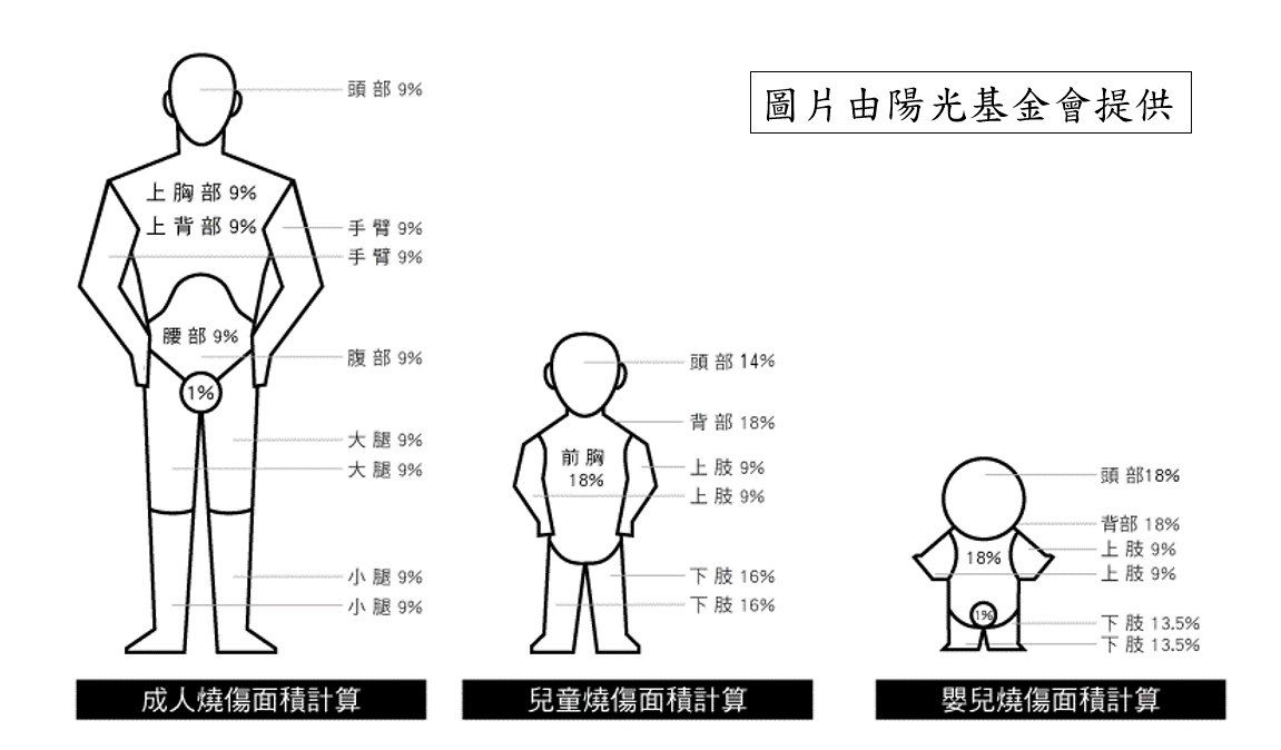 燒燙傷面積計算