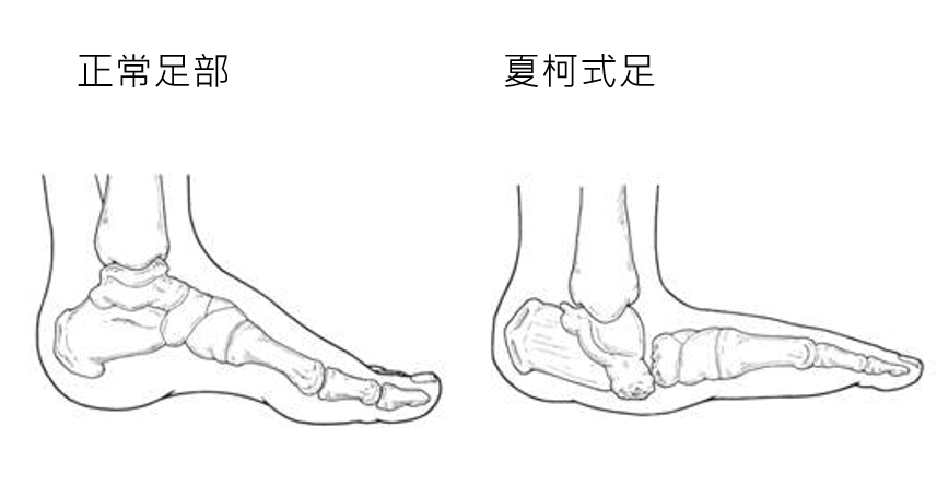正常足部與夏柯氏足 正常足部與夏柯氏足