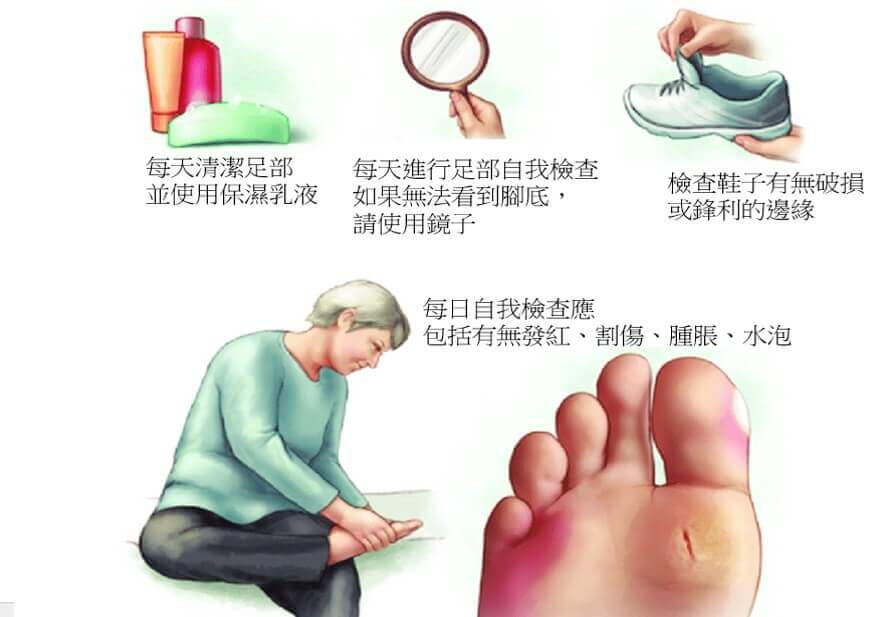 糖尿病每日足部保養 糖尿病每日足部保養