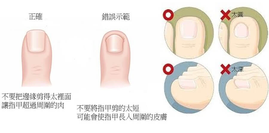 糖尿病指甲修剪方式 糖尿病指甲修剪方式