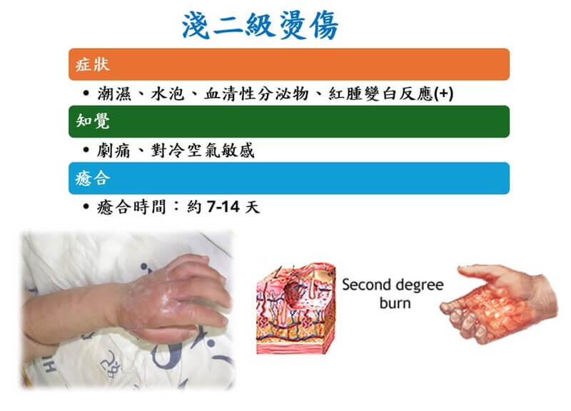 淺二級燙傷