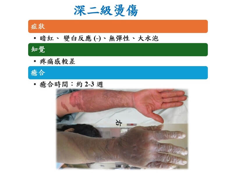 深二級燙傷
