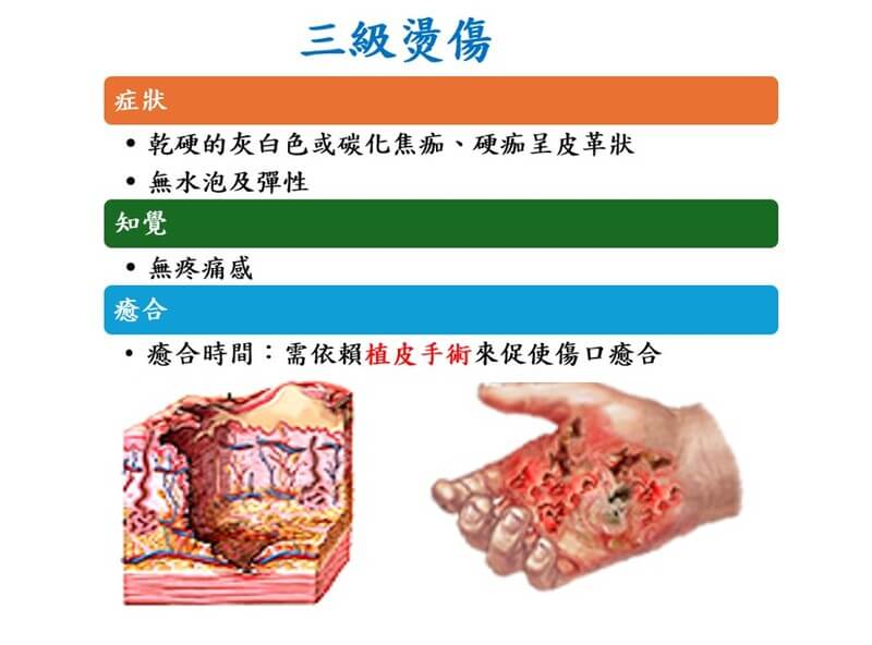 三級燙傷