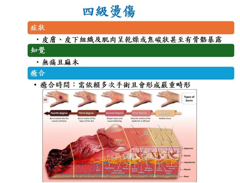 四級燙傷