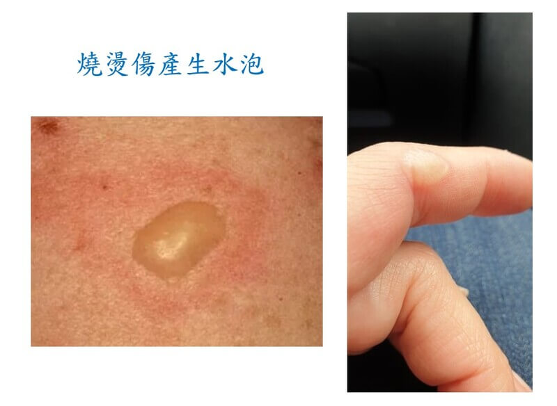 水泡處理