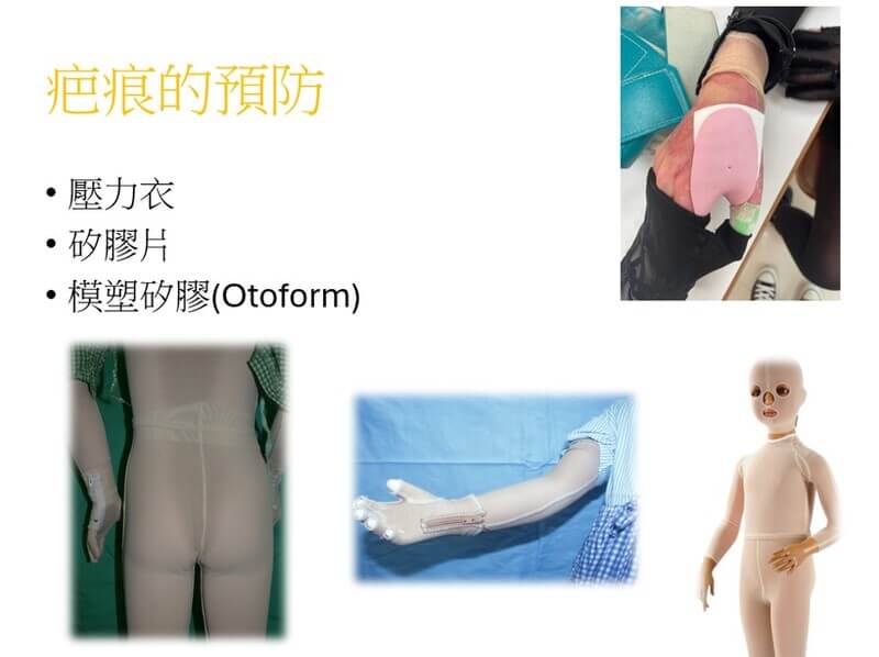 燒燙傷疤痕預防