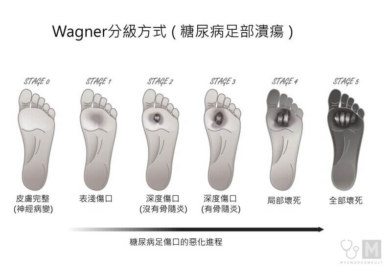 Wagner分級圖 Wagner分級圖