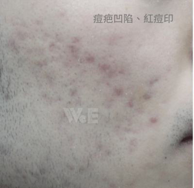色素疤 色素疤