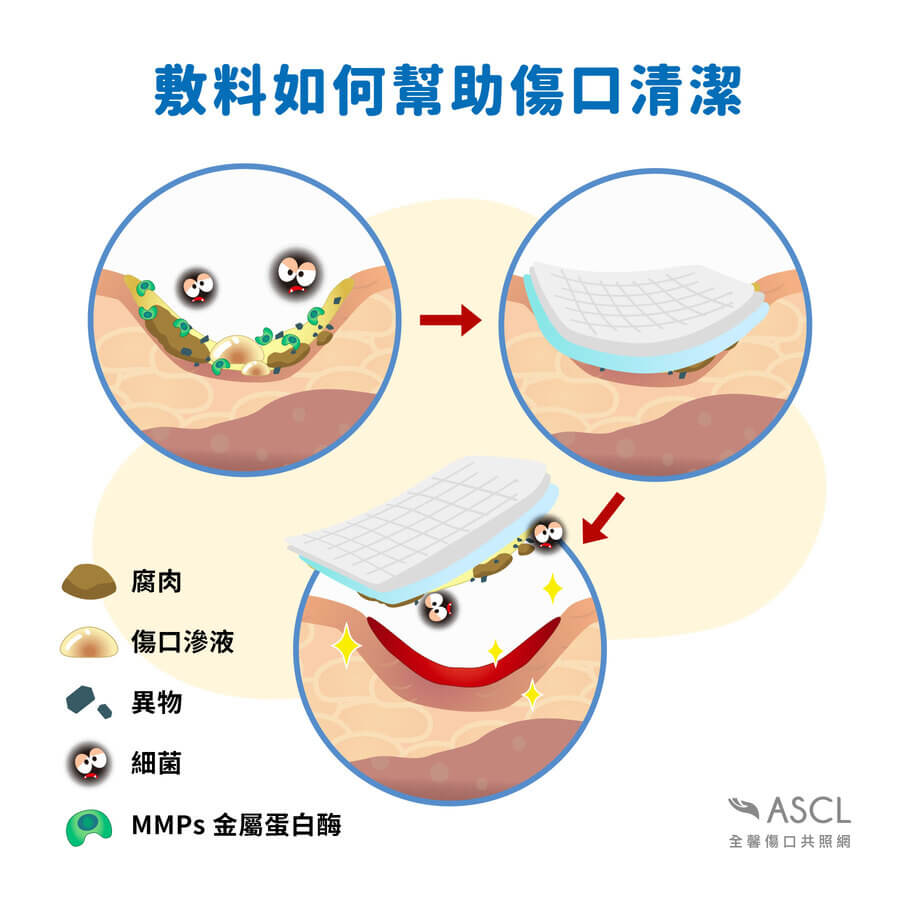 敷料如何幫助傷口清潔