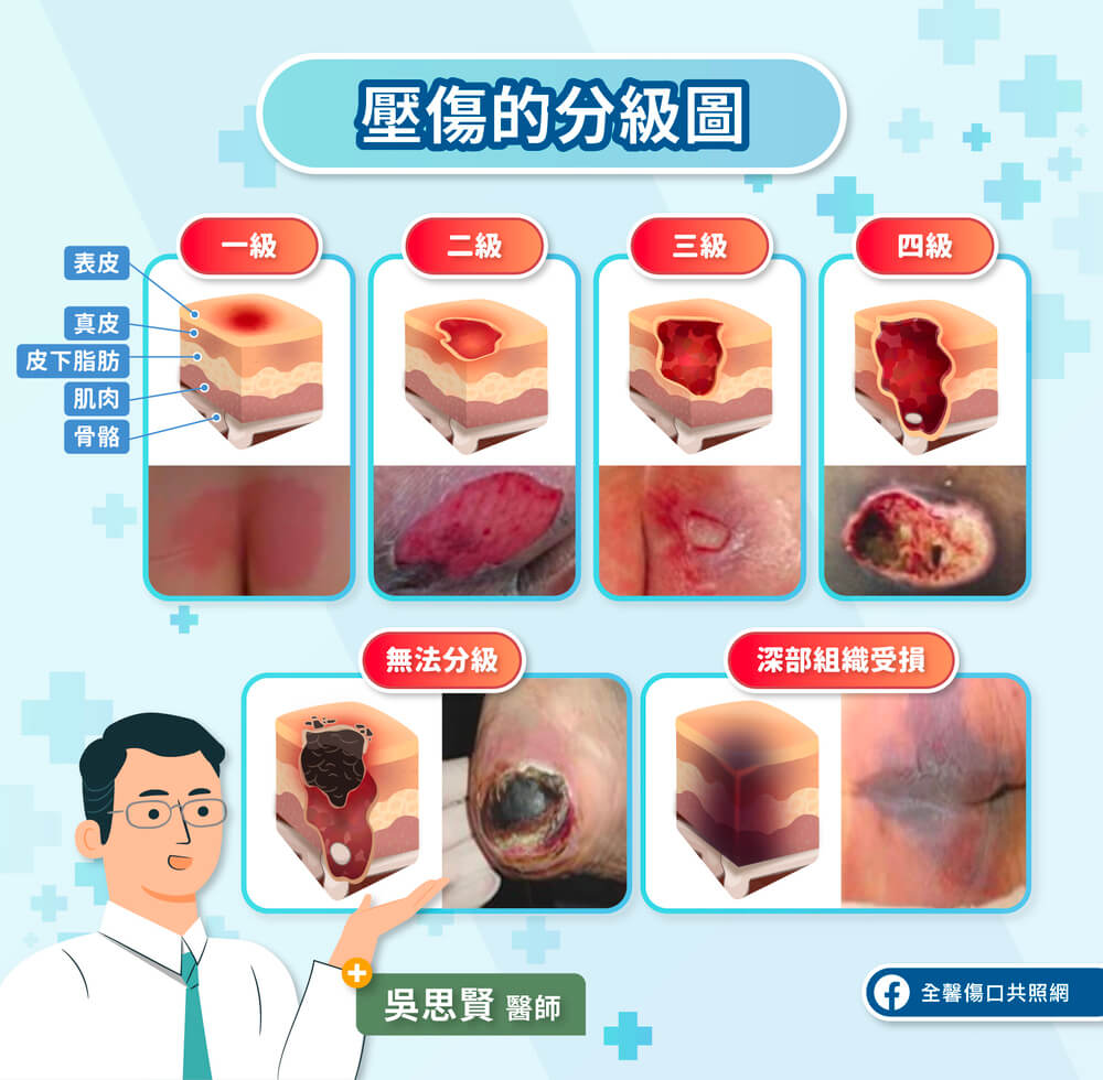 壓瘡分級圖