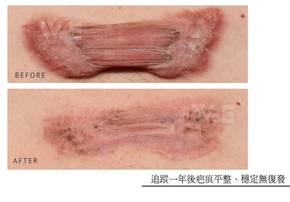 蟹足腫
