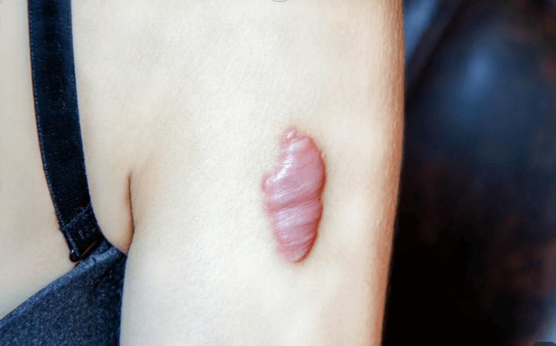 蟹足腫疤痕治療 蟹足腫疤痕治療