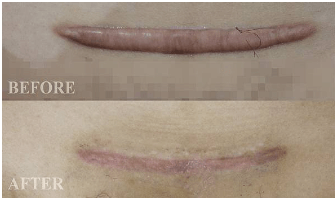 剖腹產疤痕治療 剖腹產疤痕治療